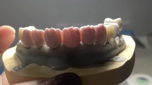 3D resin printing base with zirconia crowns layered staining and glaze asethetic effect